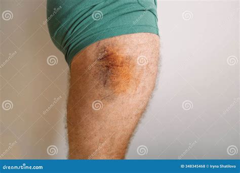 Thigh Injury from a Collision, Impact or Fall, Bruised Man Leg. Injury.Huge Yellow-blue Bruise ...