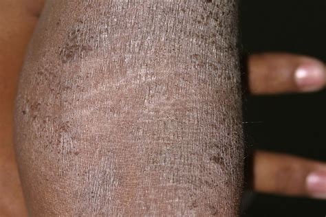 Eczema On Upper Arms Eczema Herpeticum: Pictures, Stages And Treatment