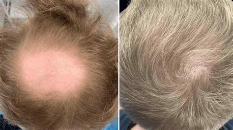 Double Crown vs Balding: What Is the Difference?