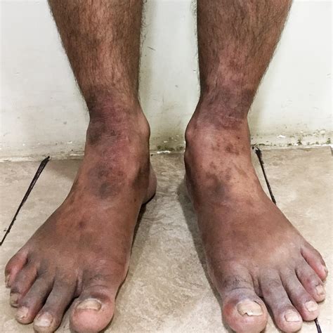 Nummular Eczema vs Ringworm | Symptoms & Treatment Guide