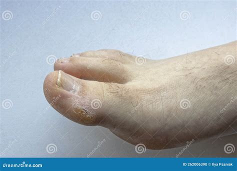 Painful Callus on the Big Toe Stock Photo - Image of nail, illness: 262006390