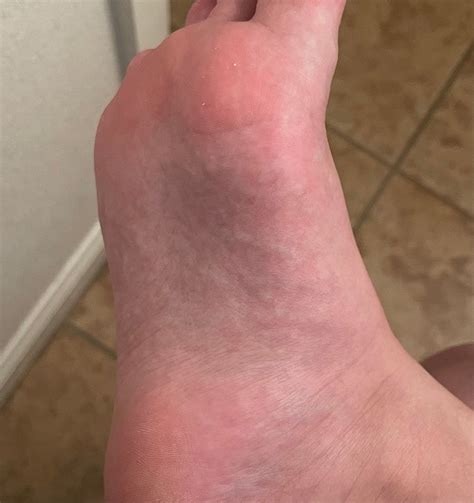 Little Itchy Bumps On Bottom Of Foot Outlet | emergencydentistry.com