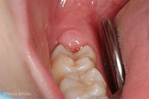 Pericoronitis (Wisdom tooth pain) — Nova Smiles