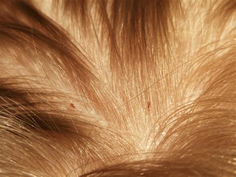 Head lice and nits - HSE.ie