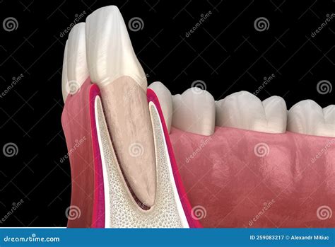 Morphology of Maxillary Lateral Incisor Tooth and Gum. Medically ...