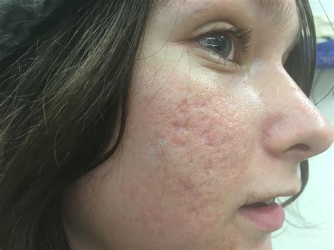 CO2 laser in treating acne scars - ultrapulse & Subcision of Acne Scars ...