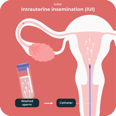 Understanding the IUI Procedure: A Complete Overview