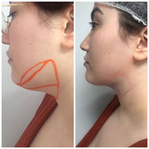 Double chin lipo done today - Before and Immediately after procedure : r/PlasticSurgery