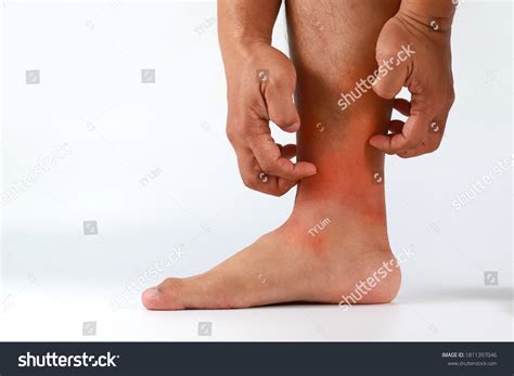 4,169 Itching legs Images, Stock Photos & Vectors | Shutterstock