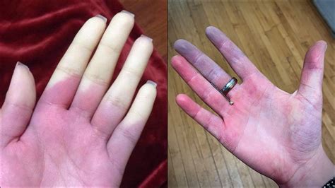 Raynaud’s Syndrome – PhysioMSK