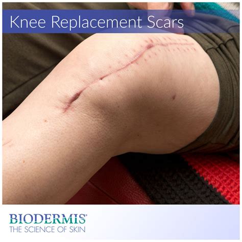 Knee Scar Removal Before And After at Bruce Moreno blog
