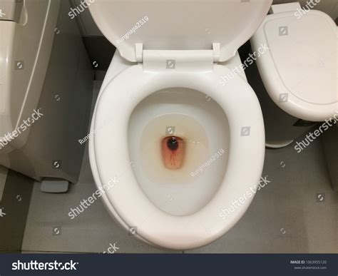 Hemorrhoids Bleeding In Toilet