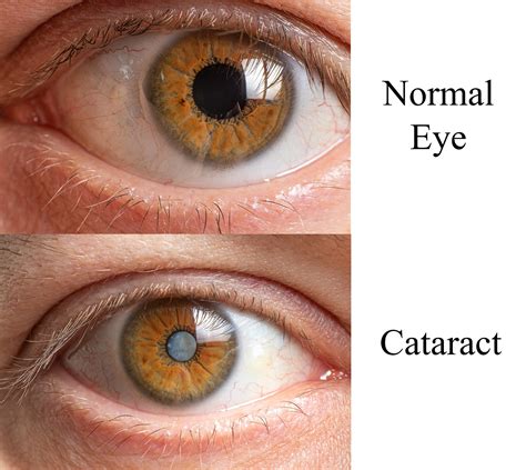 Eye Cataract Without