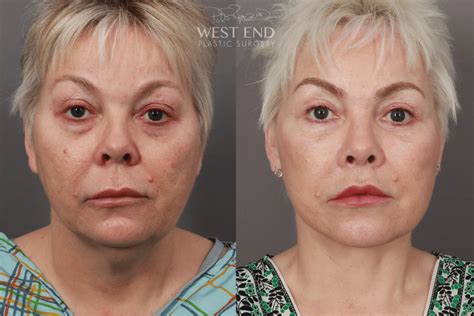 Deep Plane Facelift & Neck Lift, Eyelid Lift, Lip Lift, and Fat Grafting (9 Months Post-Op ...