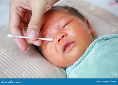 A Baby With Eyes Full Of Rheum, Produced By Conjunctivitis, Inflammation Of The Conjunctiva Of ...
