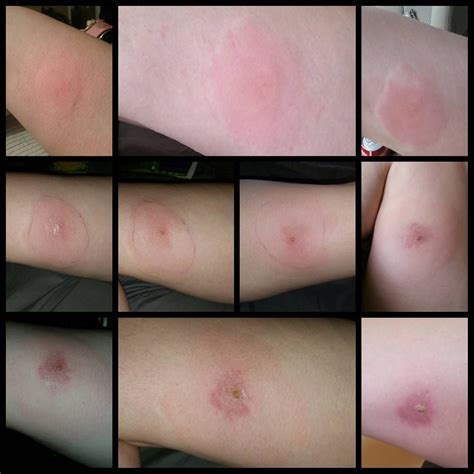 Types Of Spider Bites That Itch at Jaime Chandler blog