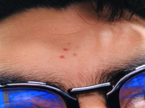 Throwing Up And Red Dots On Face at Elizabeth Wells blog