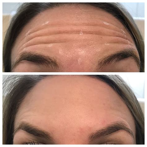 Pin de Brittany Perez em Cosmetic Injectables | Botox rosto, Botox facial, Estética facial