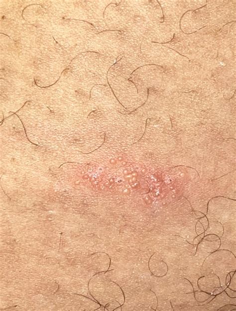 Just got told this might be shingles. I’m 22, have never had chickenpox and have had the ...
