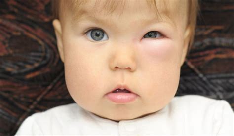 10 Causes of Swollen and Goopy Eyes in Babies - Swollen Eyelid