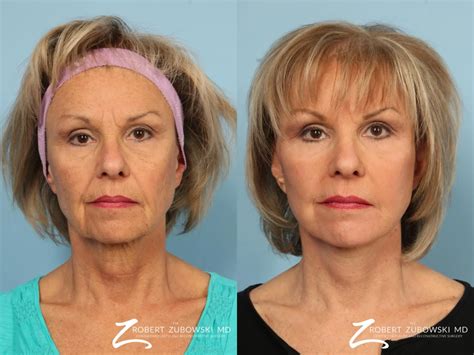 What Is The Best Age For A Mini Facelift at Christy Bodner blog