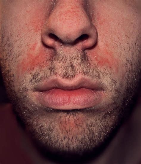 Seborrheic Dermatitis and Rosacea | Rosacea.org