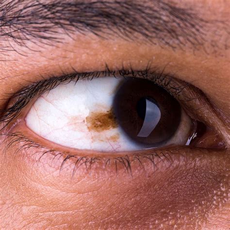 Eye Melanoma: 6 Risk Factors & Symptoms to Watch | Vejthani