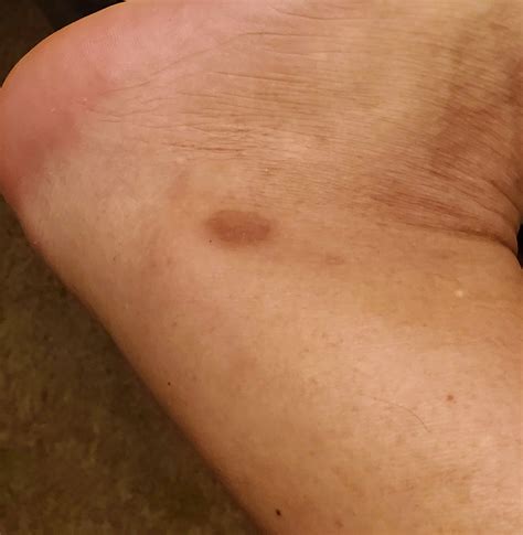 Brown spot on left side of foot : r/Dermatology
