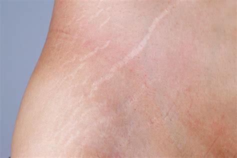 Stretch Marks Treatment at Universal Dermatology