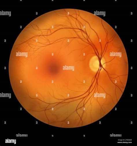Illustration showcasing a healthy, normal retina as observed during ophthalmoscopy, displaying ...