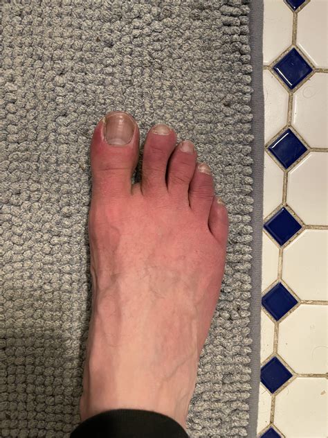 Toes of both feet become red and itchy at night : r/DermatologyQuestions
