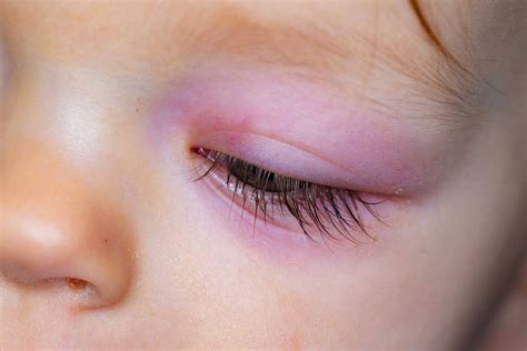 Eye Swelling Infant at Anna Kowalski blog