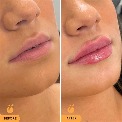 Lip Injections Before And After
