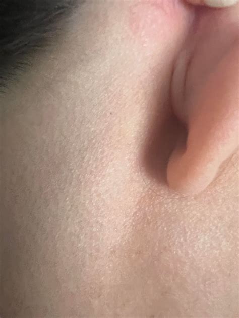 Hard fixed lump behind ear : r/DiagnoseMe