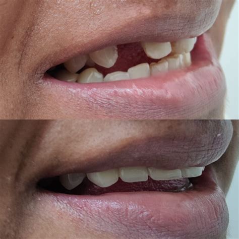 Dental Crowns And Bridges In Noida – Best Dental Clinic In Noida | Top Dentist In Noida