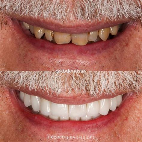 Case Studies - Frontier Dental Laboratories