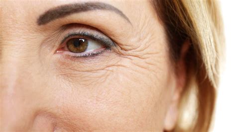 What causes Crows Feet and what treatments are there?