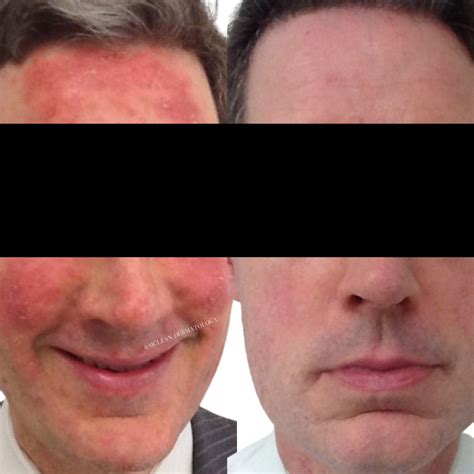 Rhinoplasty los angeles nose surgery beverly hills – Artofit