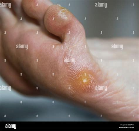 Plantar wart and callus on the patient's foot. Removal of warts and ...