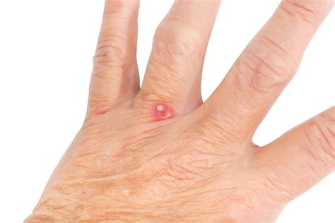 14 Common Bug Bite Pictures - How to ID Insect Bites and Stings
