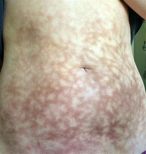 Burn Fat With Heating Pad at Jamie Gibb blog