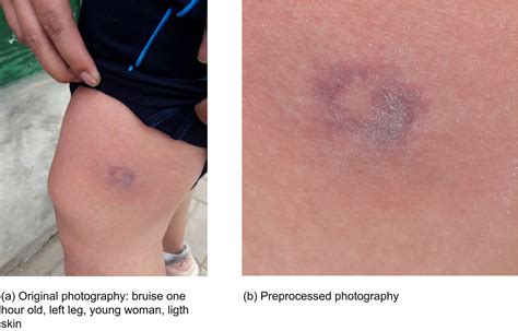 Bruise dating using deep learning - Tirado - 2021 - Journal of Forensic ...