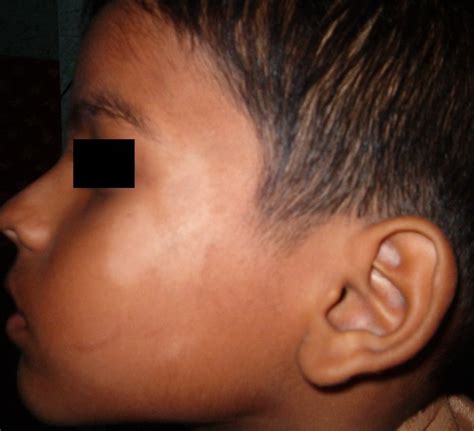 Pityriasis Alba - Pictures, Causes, Symptoms, Treatment - HubPages