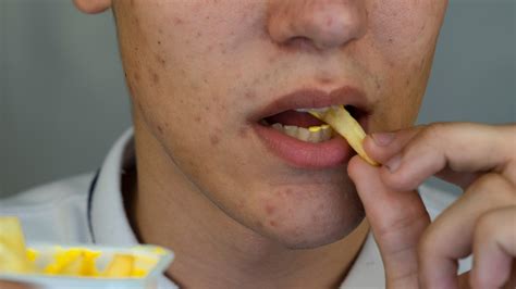 Which Foods Can Cause and Help Prevent Acne? - GoodRx