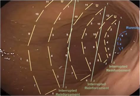 Endoscopic Sleeve Gastroplasty - Gastrointestinal Endoscopy Clinics