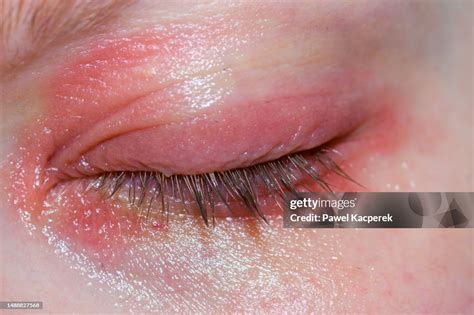 Inflammation Of The Eyelids Reddened Skin Allergy Swelling Rash High ...