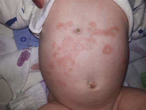 Lupus Eritematoso Neonatal