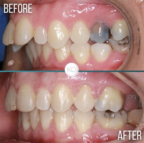 Discover How Braces Effectively Correct Overbites