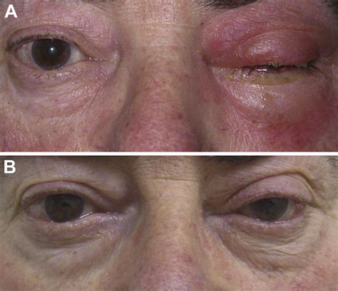 Orbital cellulitis - Survey of Ophthalmology