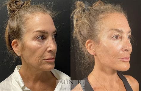 Deep Plane Facelift / Neck Lift Before and After Pictures Case 254 | Denver, CO | Ladner Facial ...